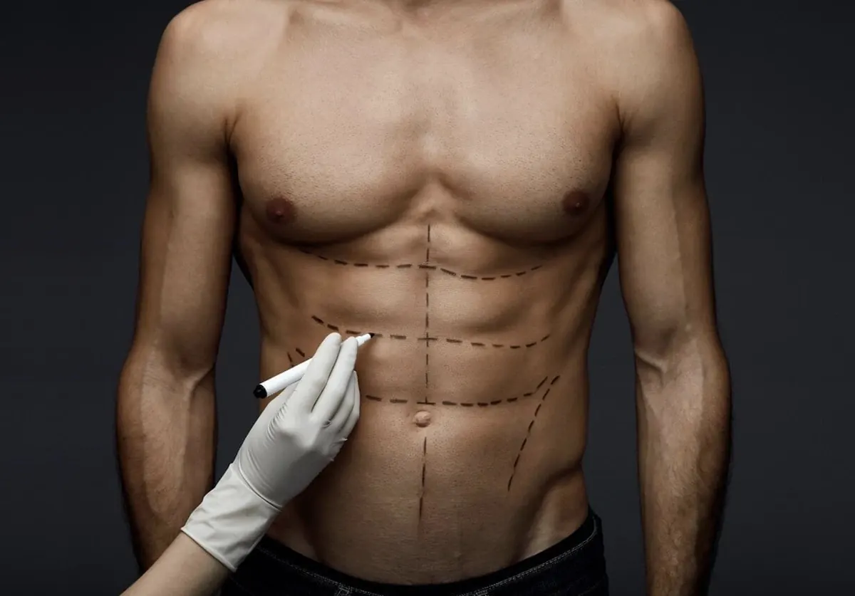 Lipoaspiração